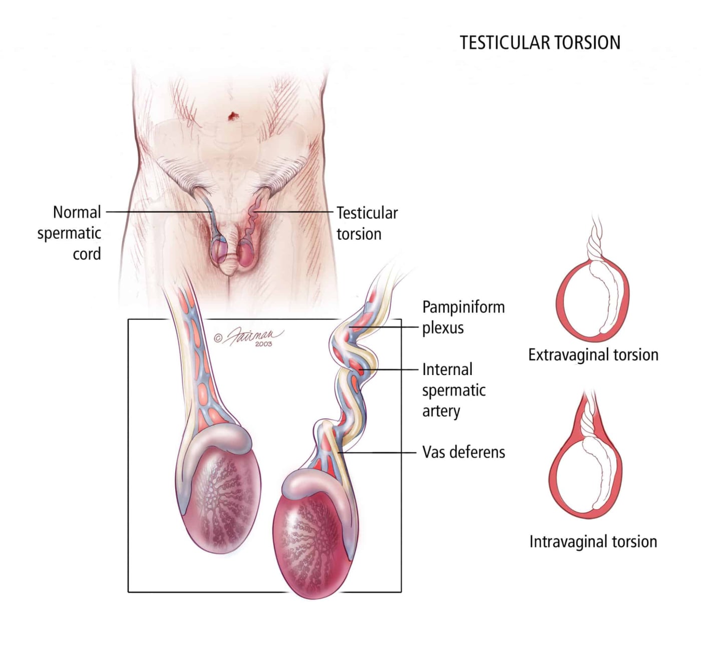 Testicular Torsion: टेस्टिकुलर टॉर्सन क्या है? जानें इसके कारण, लक्षण और उपाय