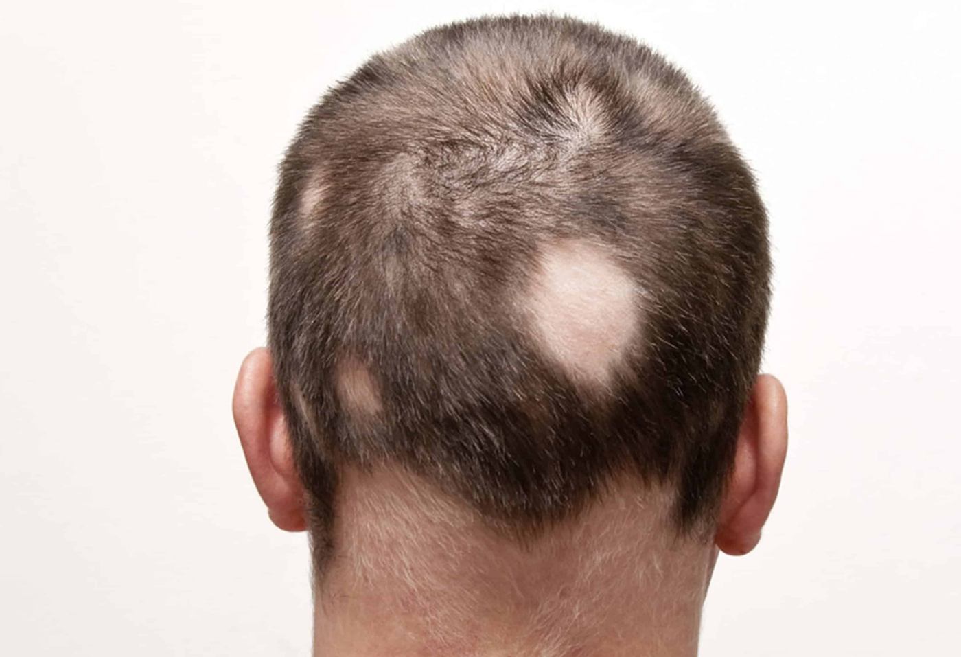 Alopecia : एलोपेसिया क्या है?
