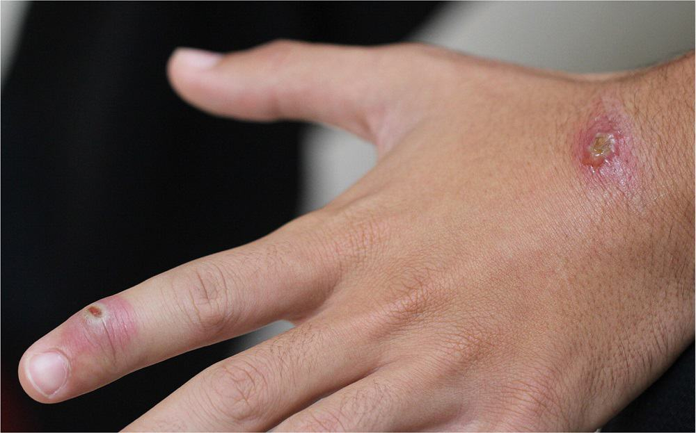 Anthrax (skin): स्किन एंथ्रेक्स क्या है? जानिए इसके कारण, लक्षण और उपाय