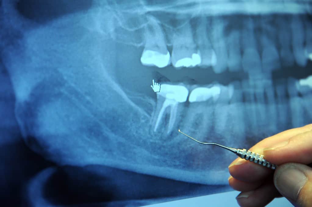 broken jaw: जबड़े में फ्रैक्चर क्या है?