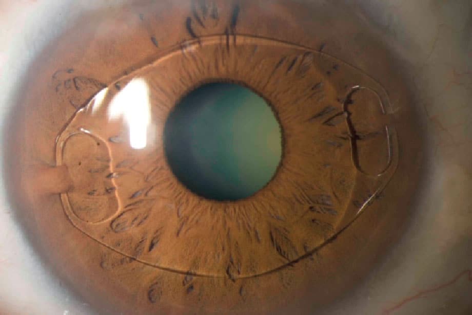 Corneal abrasion : कॉर्निया में घर्षण क्या है? जानिए इसके लक्षण और उपचार