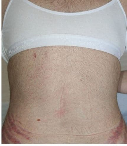 Cushing Syndrome: कुशिंग सिंड्रोम क्या है?