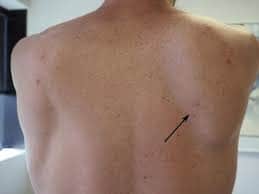 Broken Shoulder Blade: ब्रोकन शोल्डर ब्लेड क्या है? जानें इसके कारण, लक्षण और उपाय