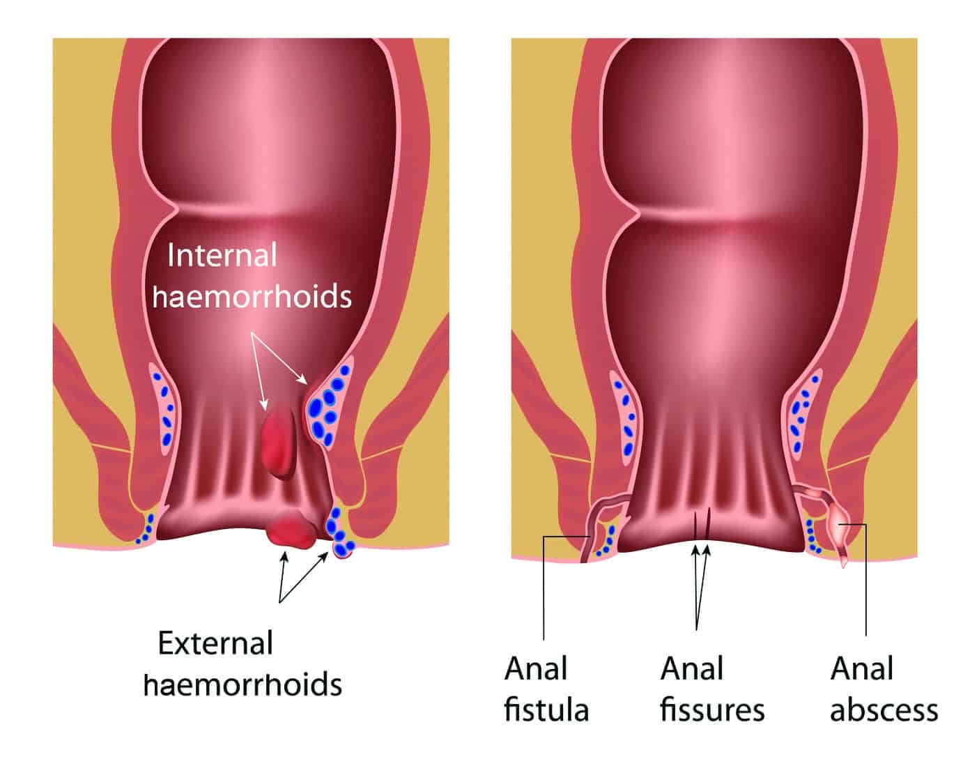 Anal Abscess : एनल एब्सेस क्या है?