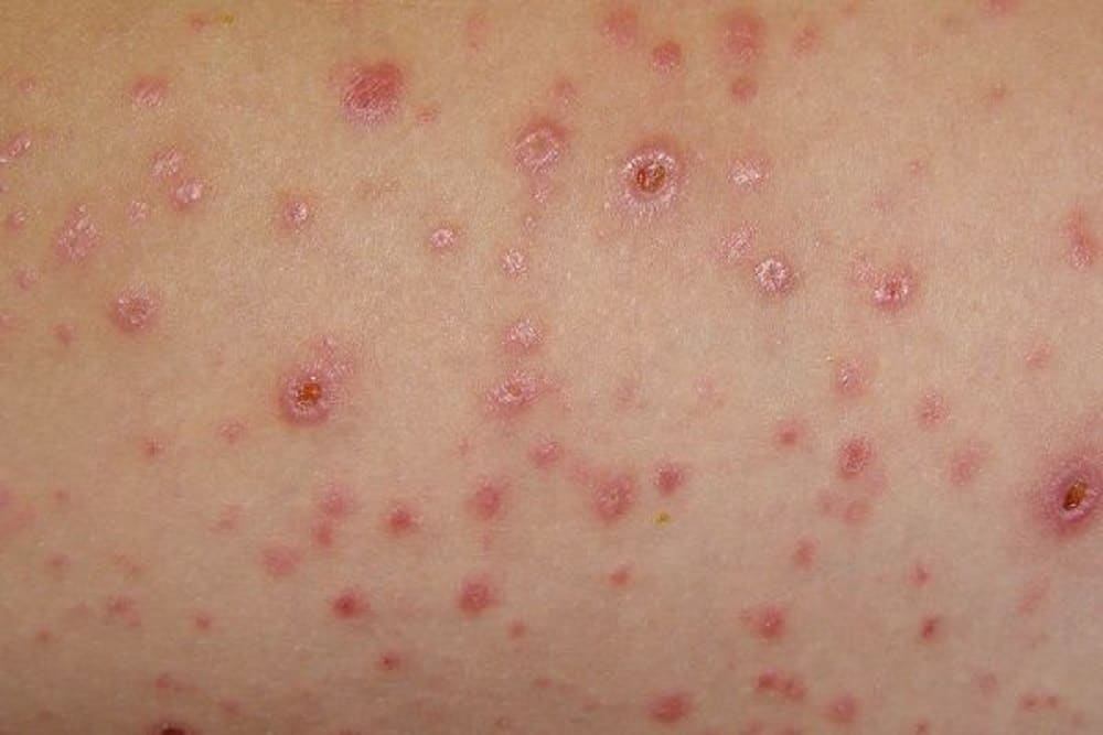 Genital Herpes: जेनिटल हर्पीस क्या है? जानें इसके कारण, लक्षण और उपाय