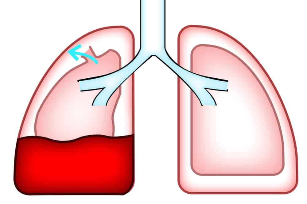 Hemothorax : हीमोथोरेक्स क्या है? जानें इसके लक्षण, कारण और उपचार