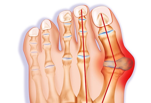 Bunions: बनियन क्या है?