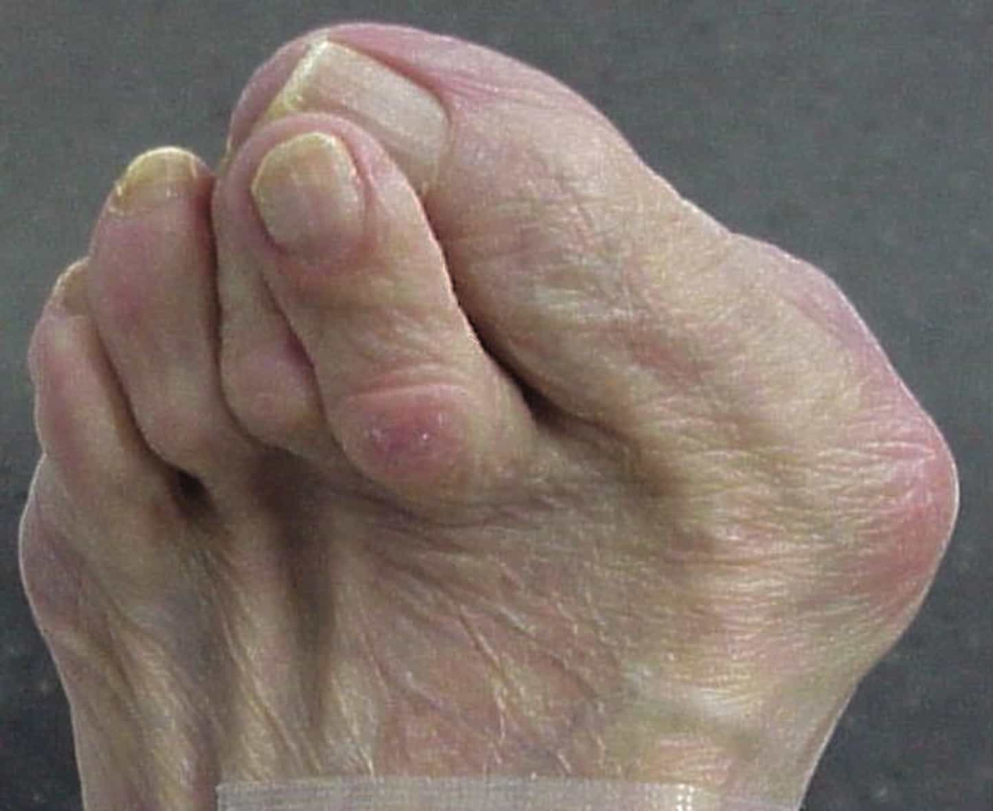 Hammer toe: हैमर टो क्या है?