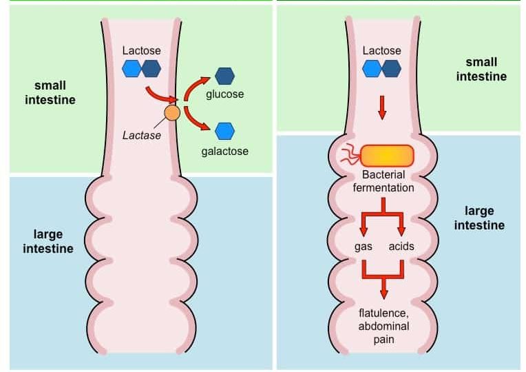 Lactose intolerance: लैक्टोज इनटॉलेरेंस क्या है?