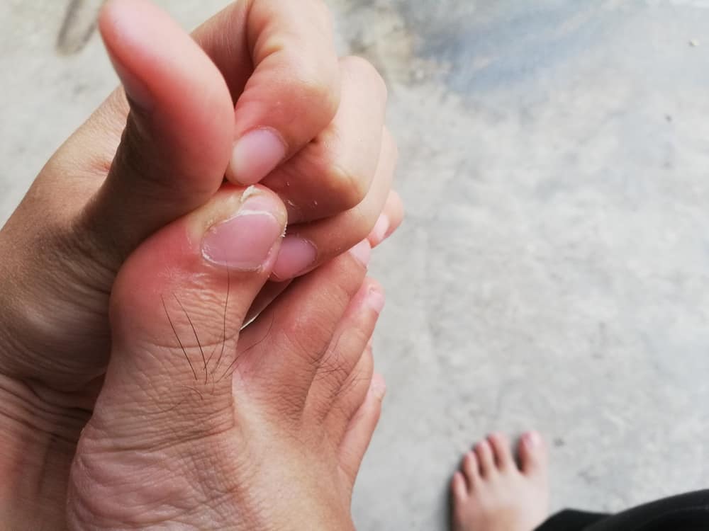 स्किन पिकिंग डिसऑर्डर क्या होता है, जानें क्यों अजीब है ये समस्या