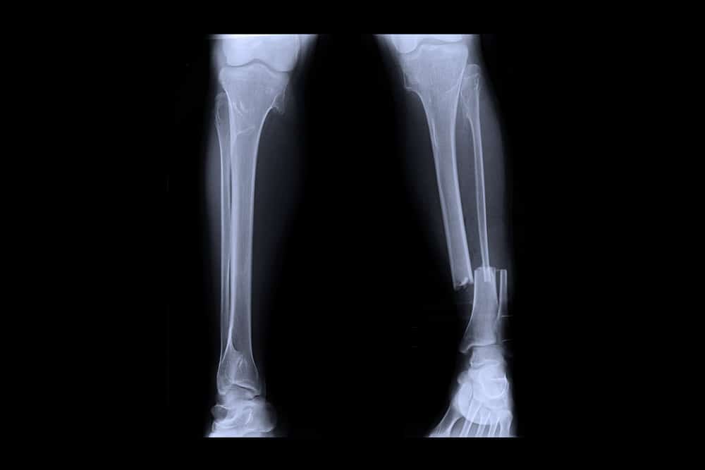 Broken (fracture) lower leg : ब्रोकन लोअर लेग क्या है?