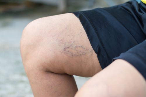 लेजर ट्रीटमेंट से होगा स्पाइडर वेन का इलाज, जानें इस बीमारी के बारे में जरूरी बातें