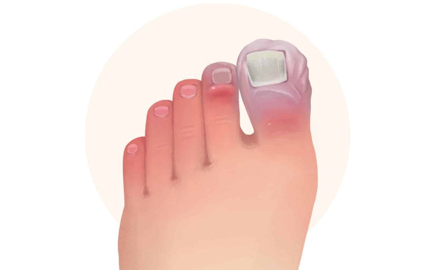 Cold Exposure: हाइपोथर्मिया क्या है?