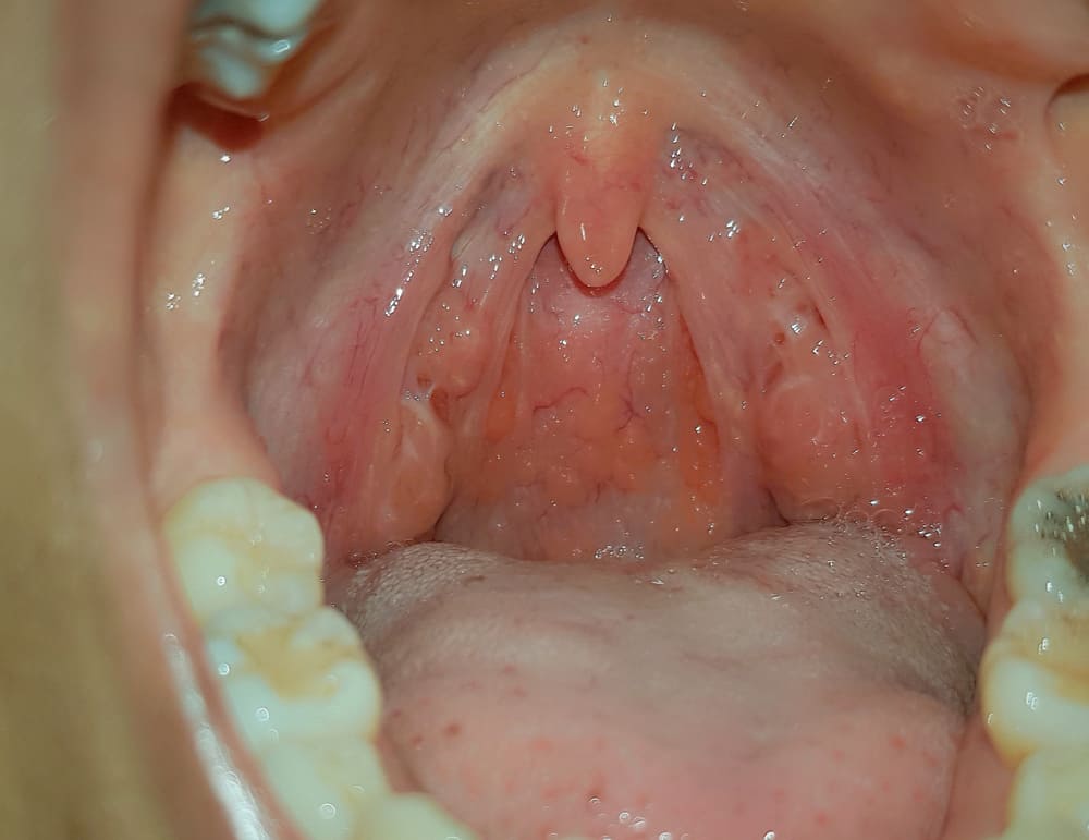 Tonsillitis: टॉन्सिल्स में इन्फेक्शन (टॉन्सिलाइटिस) क्यों होता है? जानें कारण और बचाव के तरीके