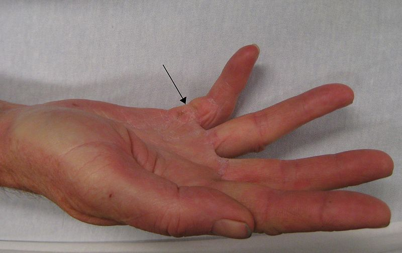 Dupuytrens Contracture: डुप्यूट्रीन का संकुचन क्या है?