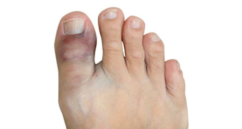 Broken (fractured) toe: जानिए पैर की उंगली में फ्रैक्चर क्या है?