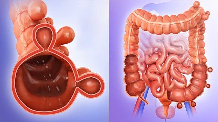 Diverticulosis- डायवर्टीकुलोसिस क्या है?