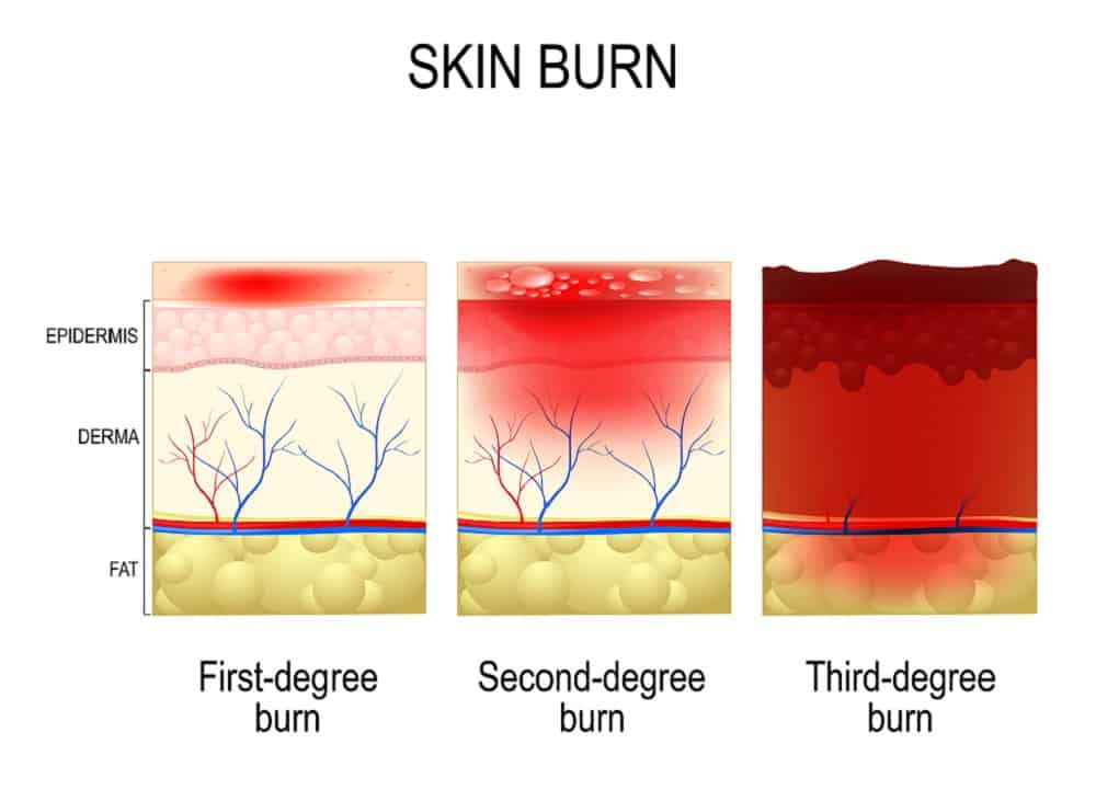 फर्स्ट डिग्री से थर्ड डिग्री तक जानिए जलने के प्रकार और उनके उपचार