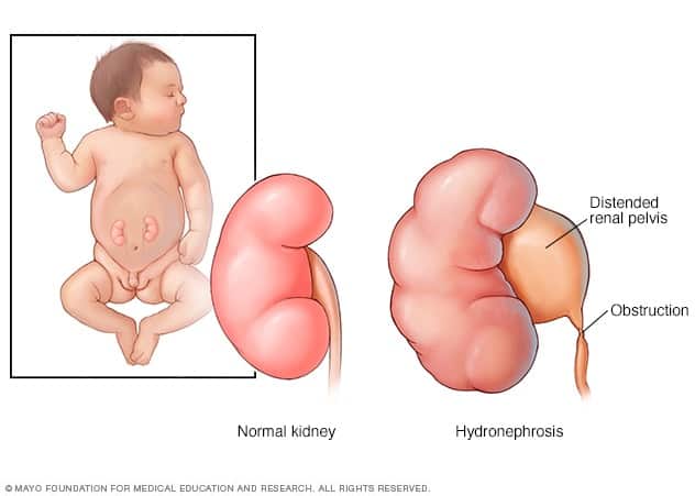 Hydronephrosis: हाइड्रोनफ्रोसिस क्या है?