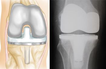 Partial knee replacement : पार्शियल नी रिप्लेसमेंट क्या है?
