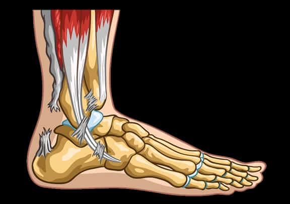 Achilles Tendon Rupture: अकिलिस टेंडन सर्जरी क्या है?