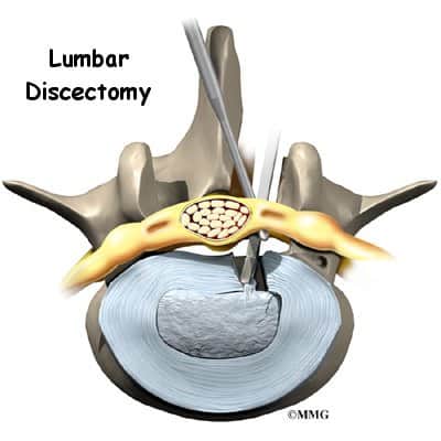 Lumbar Discectomy Surgery: लम्बर डिस्केक्टॉमी सर्जरी क्या है?