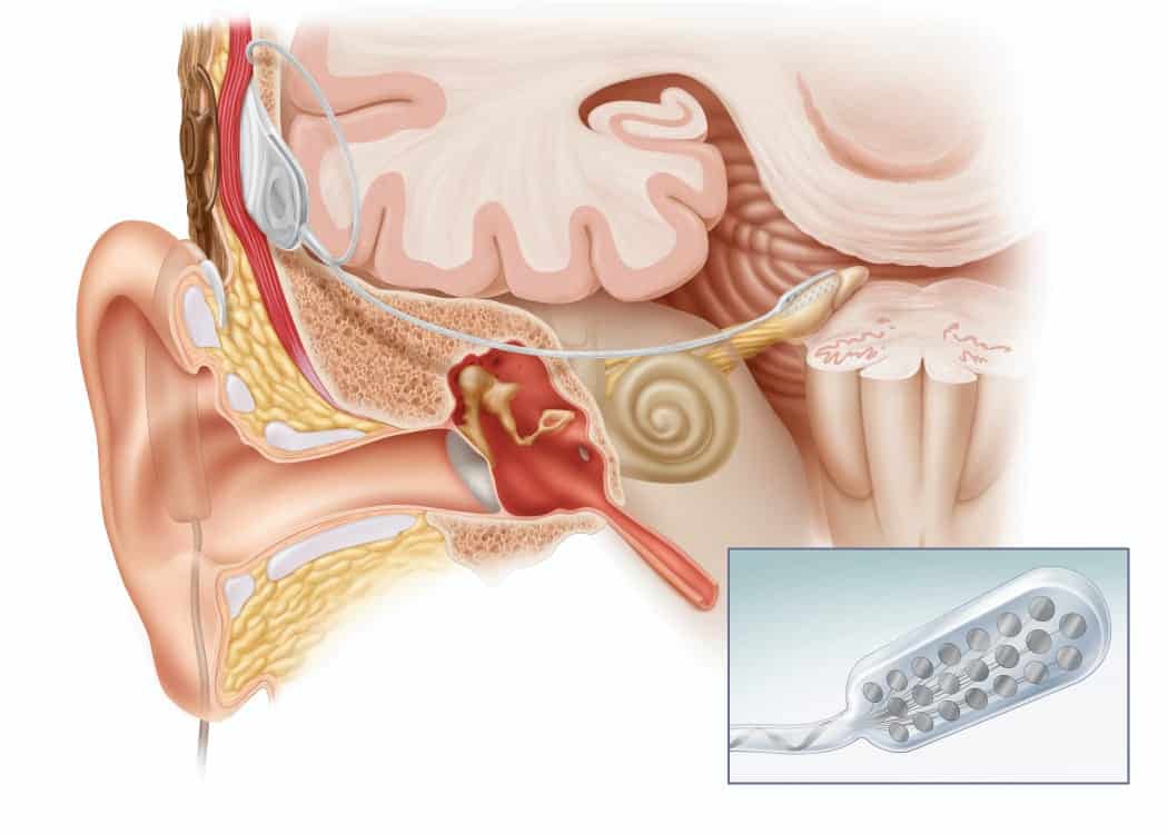 Auditory Brainstem Implants : ऑडिटरी ब्रेनस्टेम इम्प्लांट क्या है?