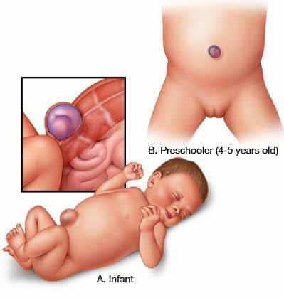 Umbilical Hernia Surgery: अम्बिलिकल हर्निया सर्जरी क्या है?