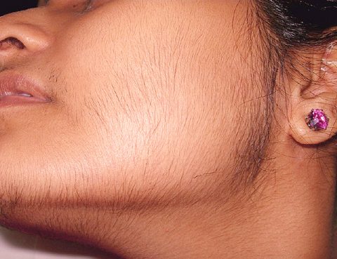 Hirsutism: हिर्सुटिज्म क्या है?