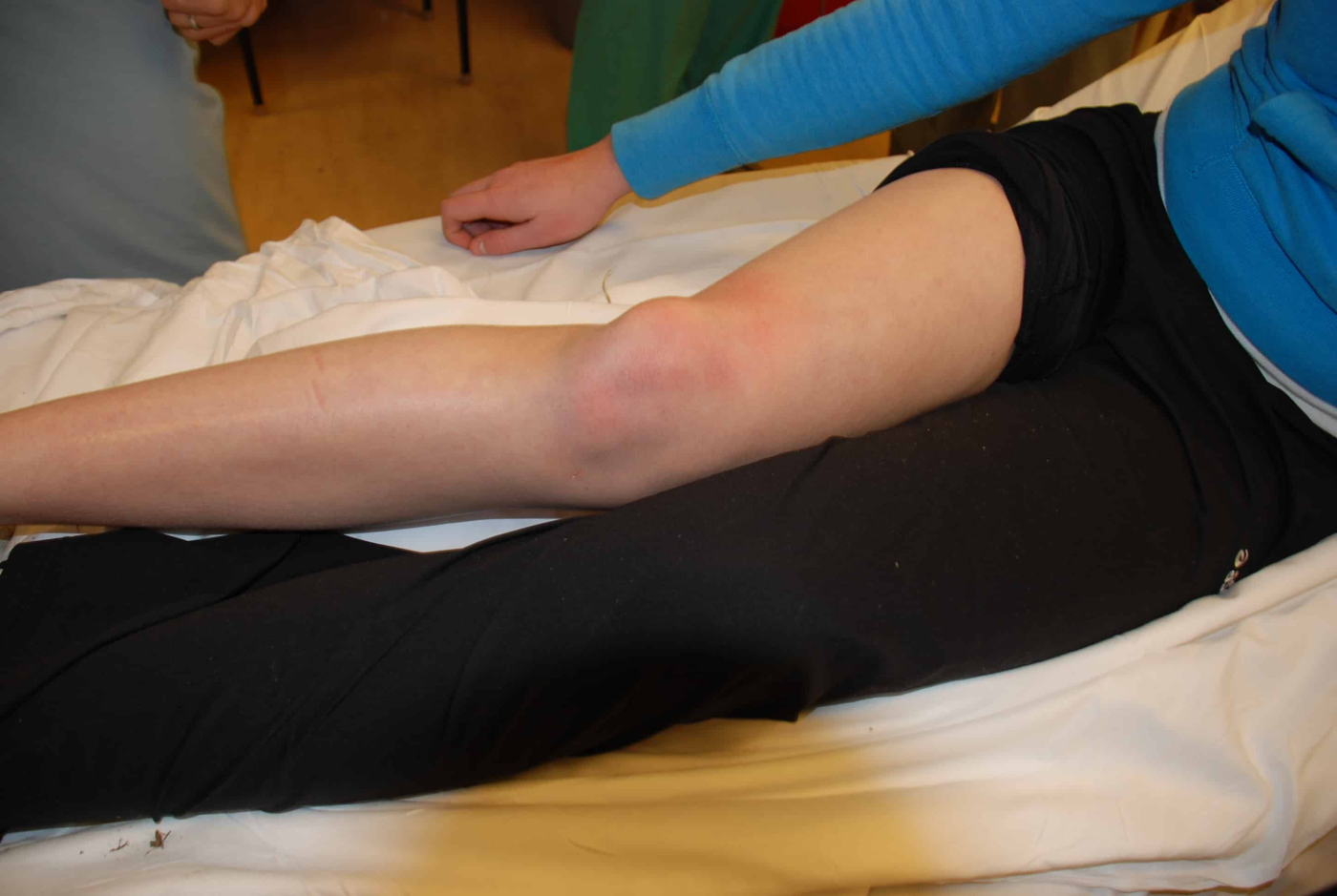 Dislocated Knee : घुटने की हड्डी खिसकना क्या है? जानें इसके लक्षण, कारण और इलाज