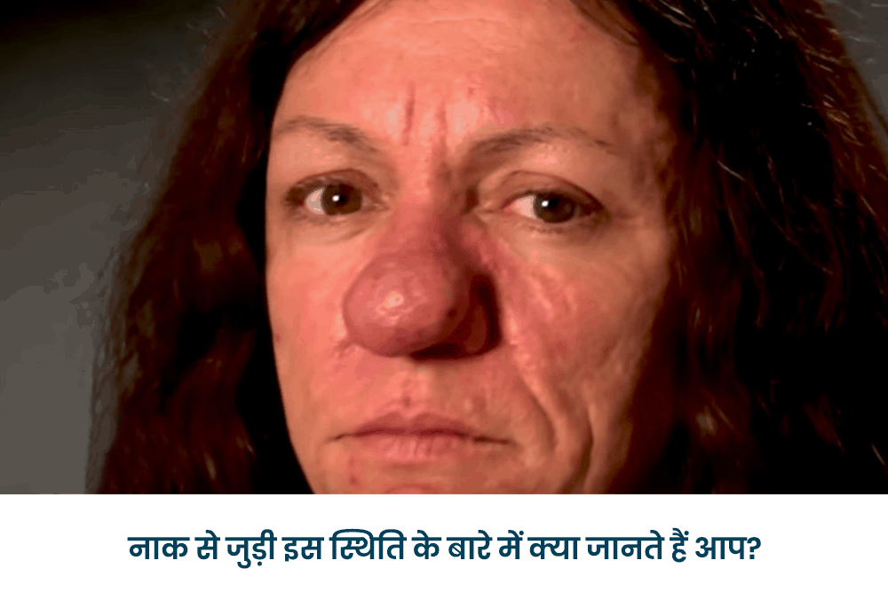 Rhinophyma: राइनोफिमा क्या है?