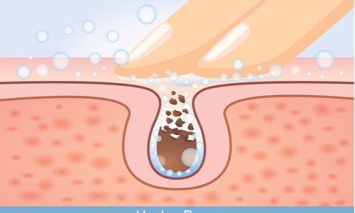 एसिड रिफ्लक्स और सांसों की बदबू में क्या संबंध है?