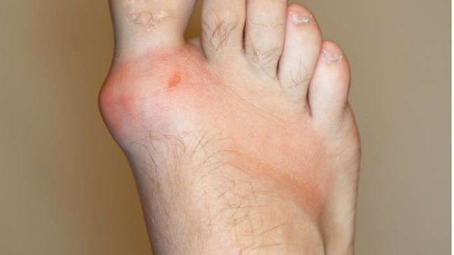 Gout: गठिया क्या है?