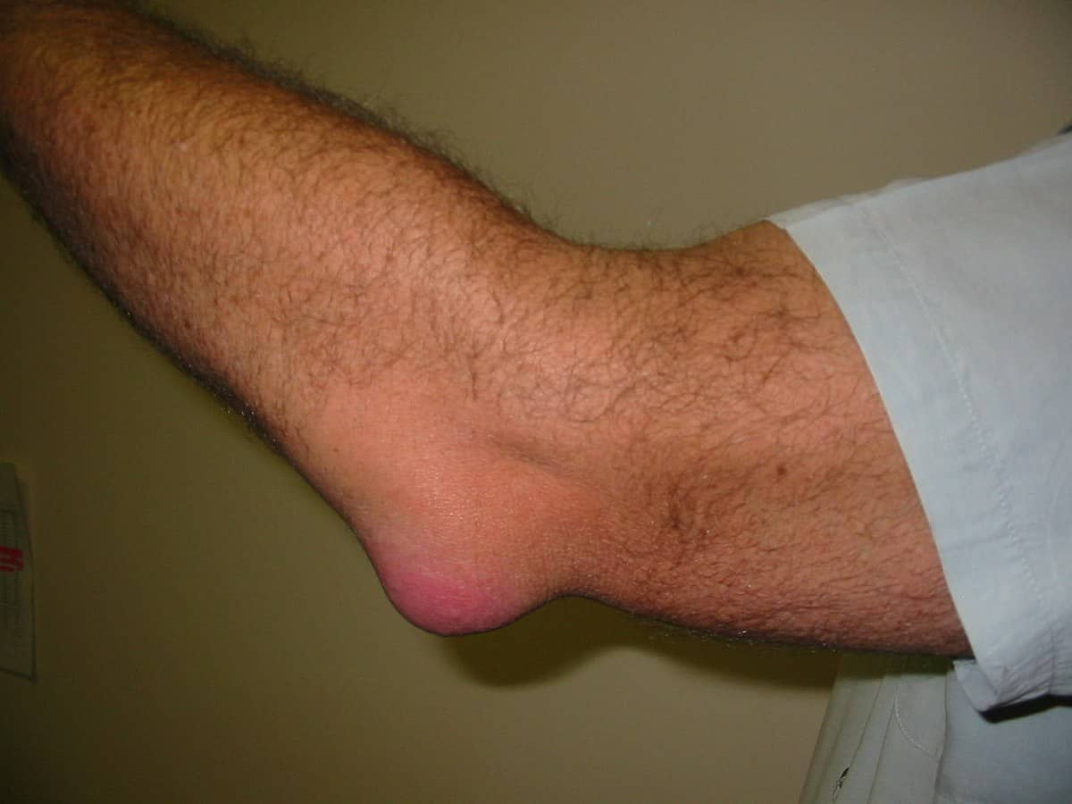 Bursitis (Anserine): बर्साइटिस (एंसरीन) क्या है?