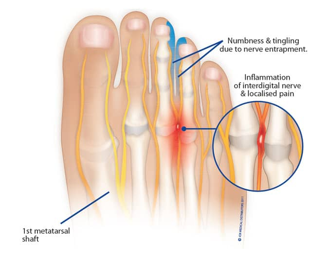 Mortons Neuroma: मॉर्टन न्यूरोमा क्या है? जानें इसके कारण, लक्षण और इलाज