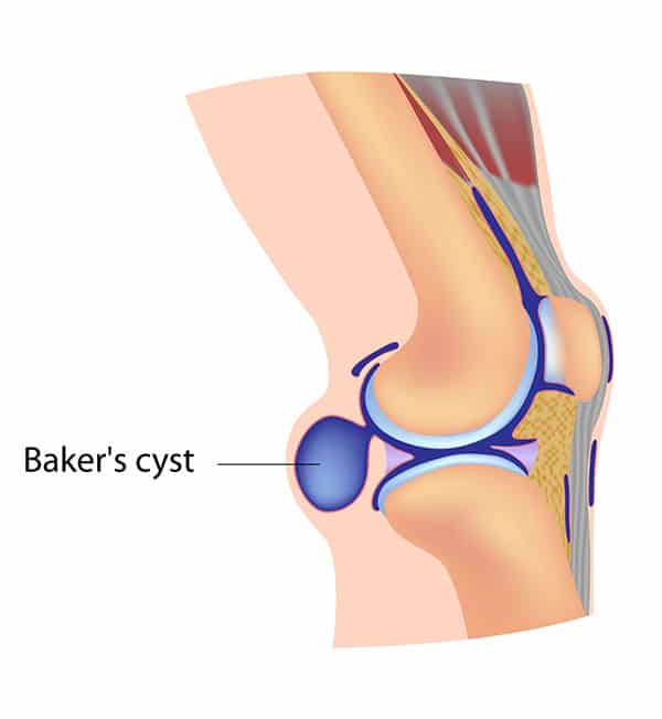 Baker cyst: बेकर सिस्ट क्या है?