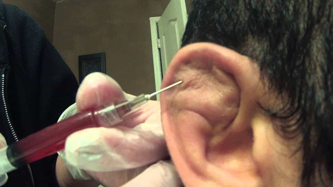 Cauliflower ear: कॉलीफ्लॉवर इयर क्या है?