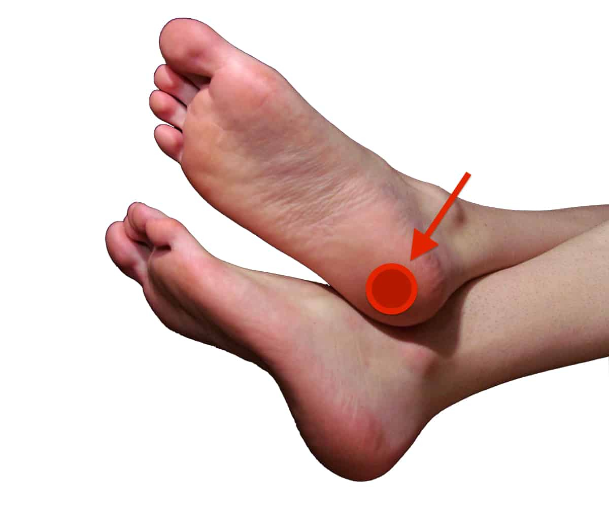 Ankle Bursitis: एंकल बर्साइटिस क्या है? जानें इसके कारण, लक्षण और उपाय