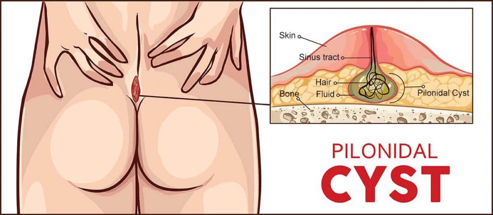 Pilonidal cyst- पिलोनाइडल सिस्ट क्या है?