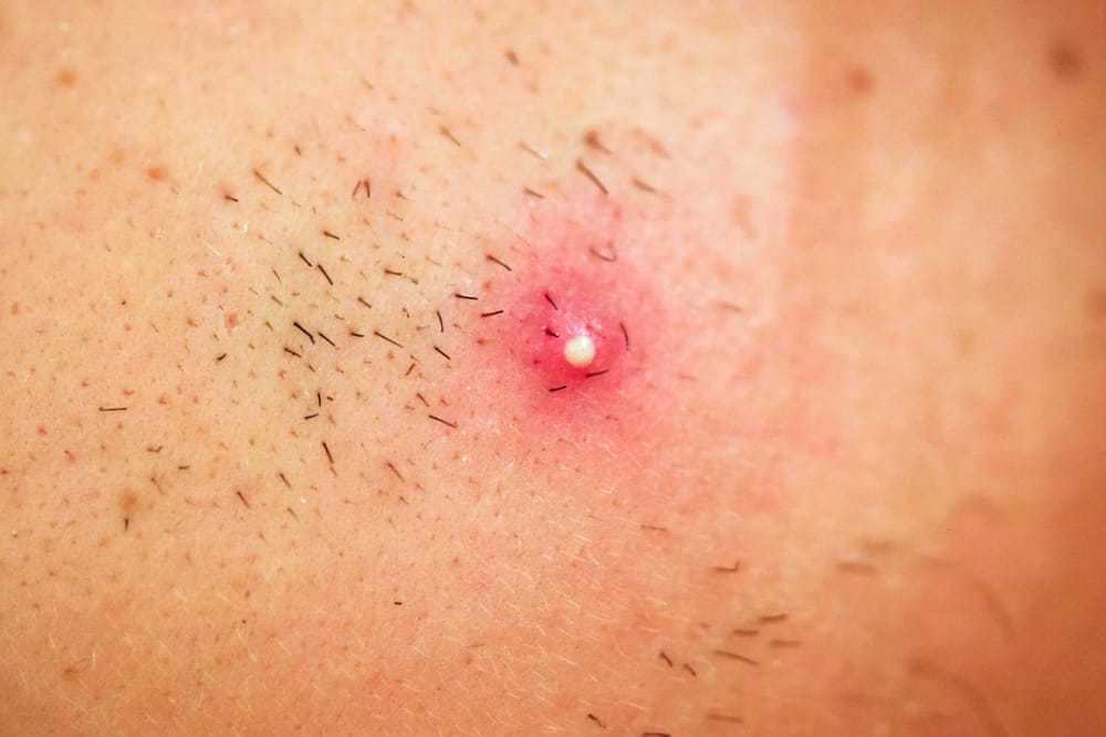 शेविंग के तुरंत बाद आ जाते हैं पिंपल? तो रखना होगा इन बातों का ध्यान