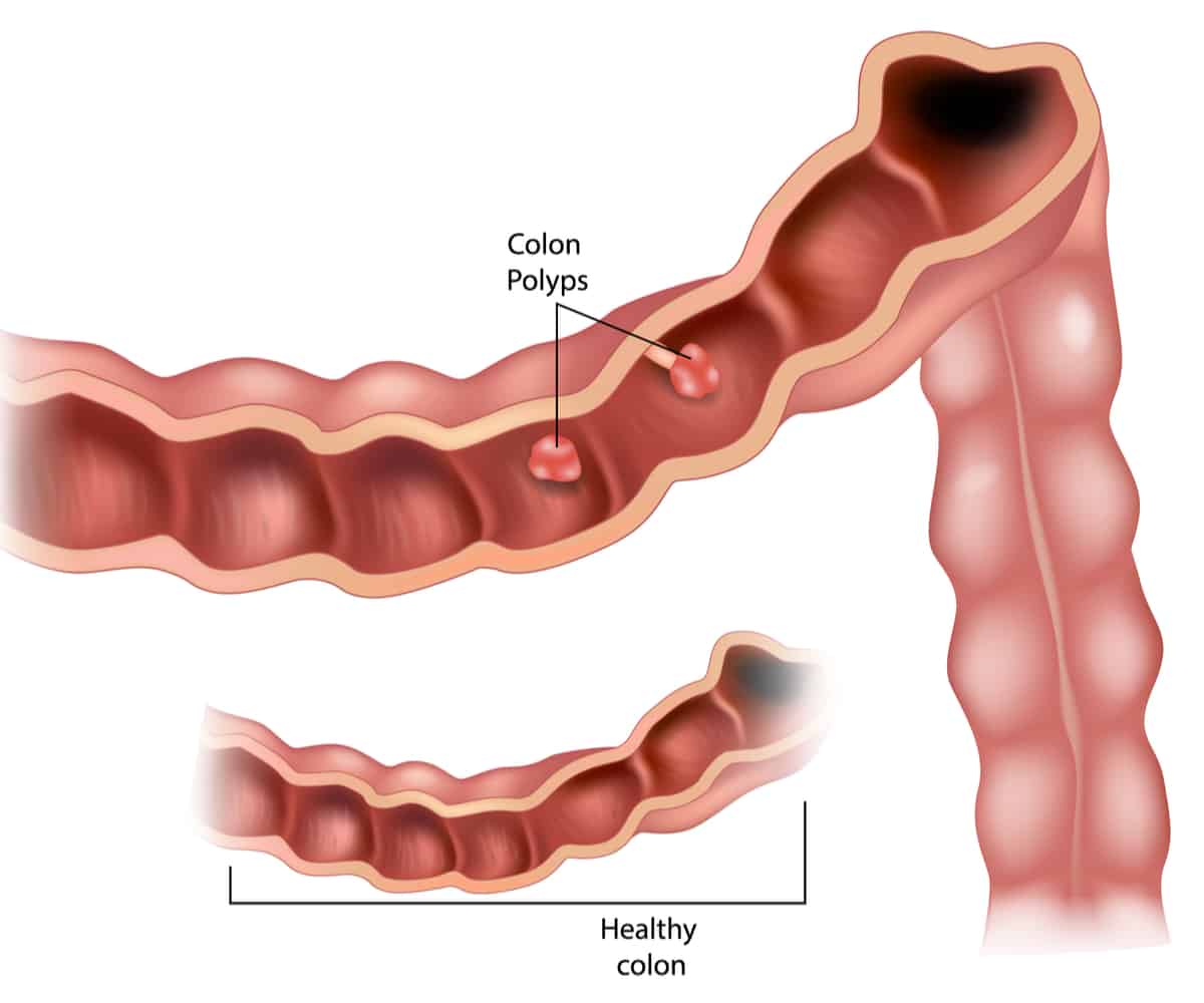 Colon polyps: कोलन पॉलीप्स क्या है? जानें इसके कारण, लक्षण और उपाय
