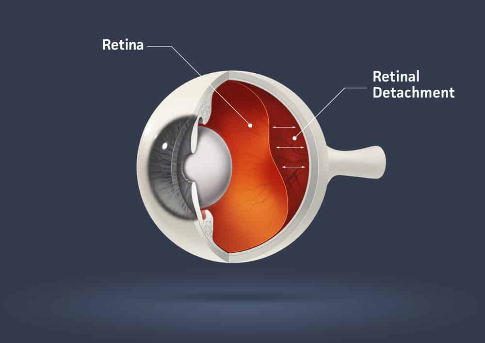 रेटिनल डिटेचमेंट (Retinal Detachment) क्या है? क्यों हो जाता है दिखाई देना बंद