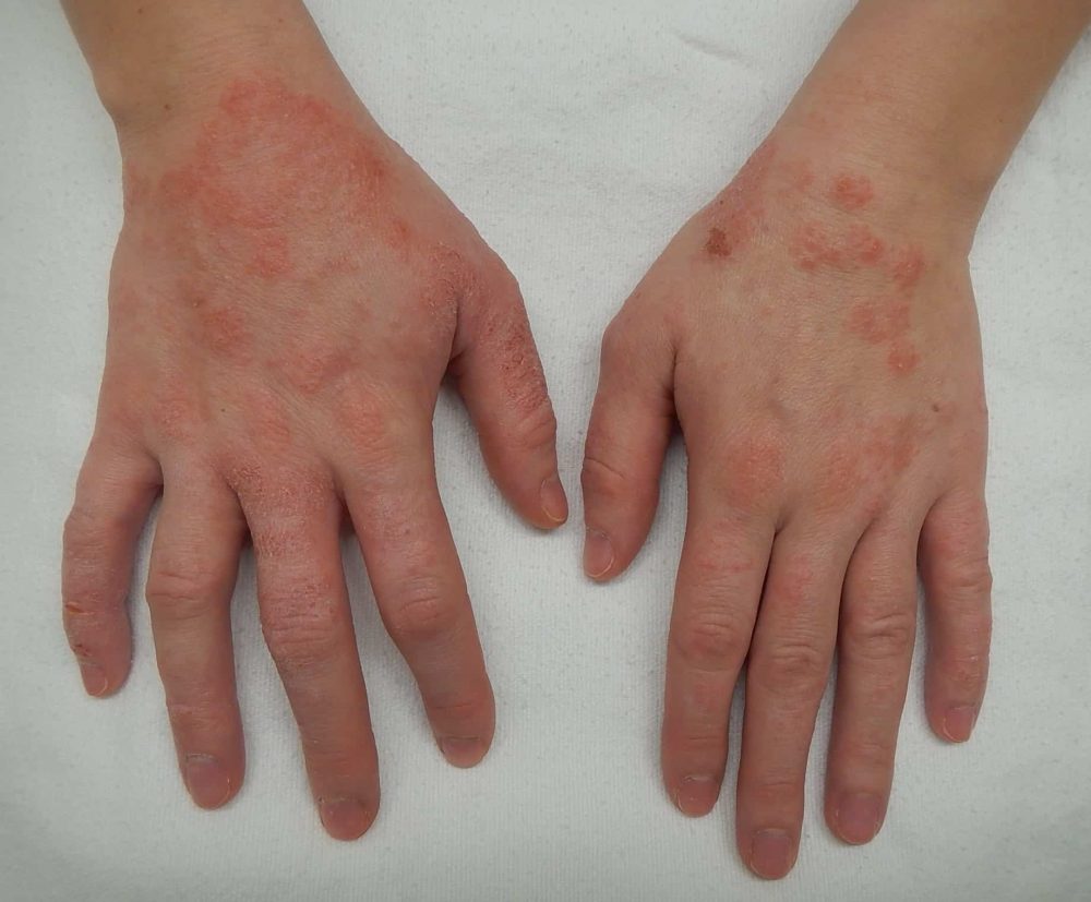 Eczema (teen and adult): एक्जिमा क्या है?