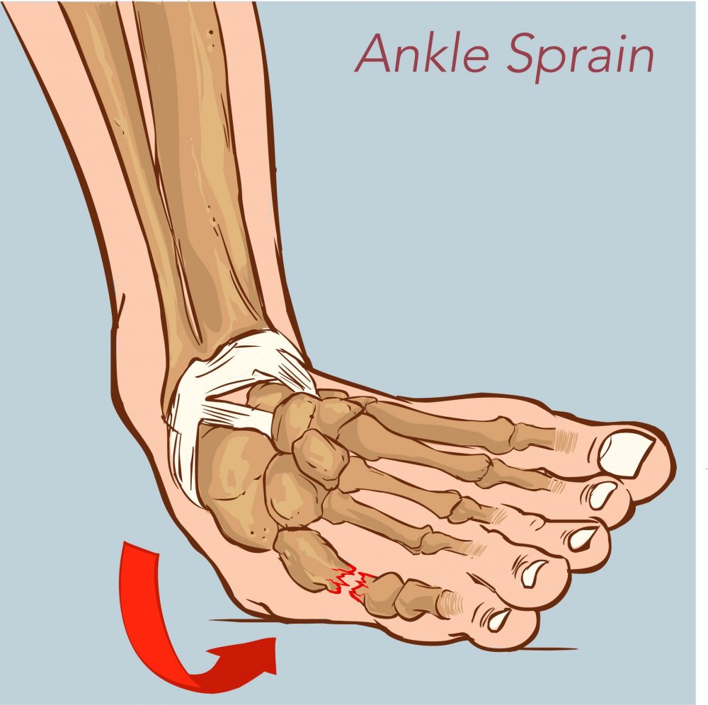 Sprained Ankle: टखने की चोट क्या है? जानें इसके कारण, लक्षण और उपाय