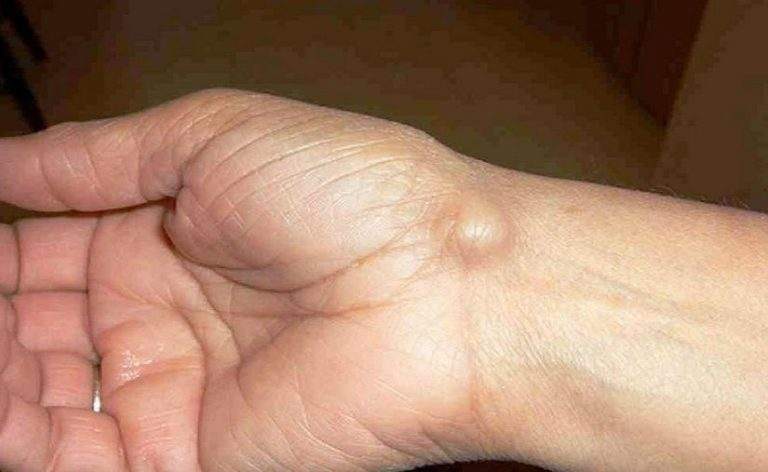 Ganglion cyst: नाड़ीग्रंथि गांठ क्या है?