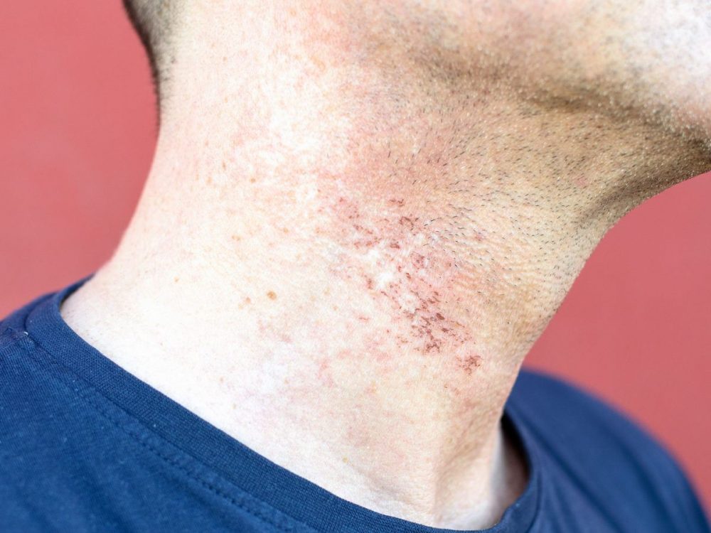 Razor bumps- रेजर बम्पस क्या हैं?