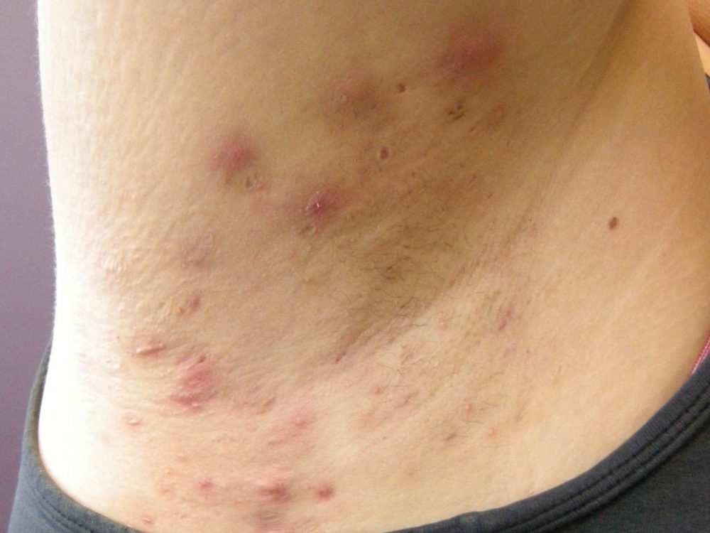Hidradenitis suppurativa: जानें हाइड्राडेनिटिस सुप्पुरातीव क्या है?
