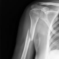 Broken (Fractured) Upper Arm: ऊपरी बांह का फ्रैक्चर क्या है? जानें इसके कारण, लक्षण और उपाय