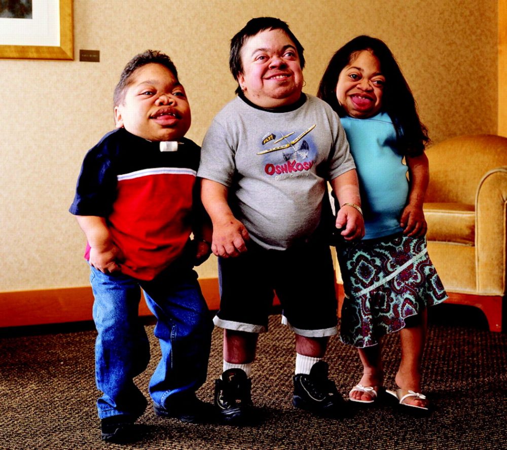 Mucopolysaccharidosis type II (MPS2): म्यूकोपोलिसेकेरीडोसिस टाइप II(एमपीएस)2 क्या है?