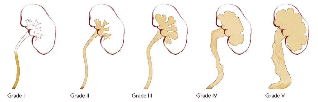 Vesicoureteral Reflux- वेसिकोरेट्रल रिफ्लक्स